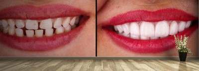 Fototapeta Piękny uśmiech stworzony przez tłoczenie licówek ceramicznych